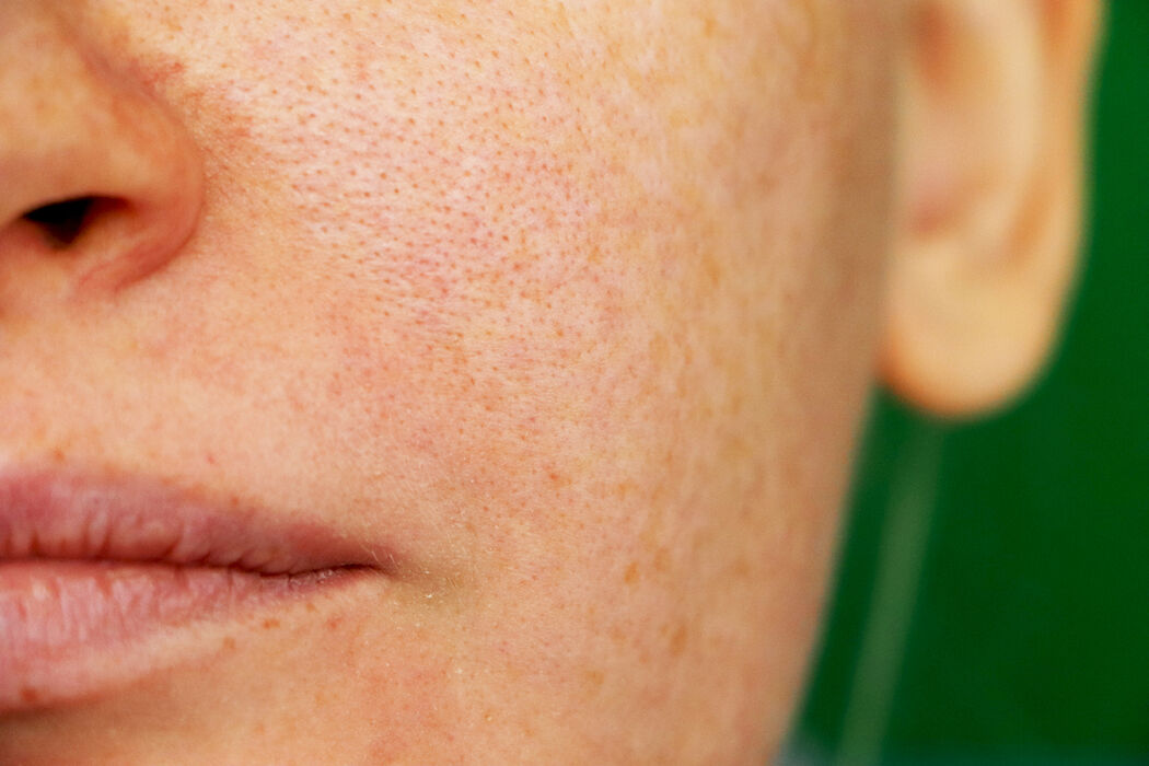 Alles over de huidziekte melasma