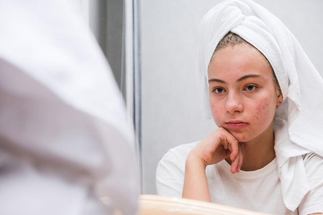 Littekens van acne zijn heel normaal: zo behandel je ze